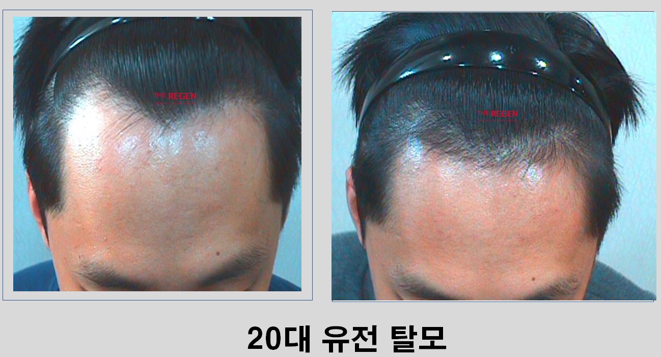 20대 유전탈모 before after